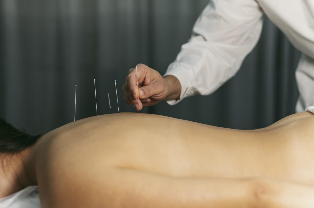 Beginner’s Guide to Acupuncture